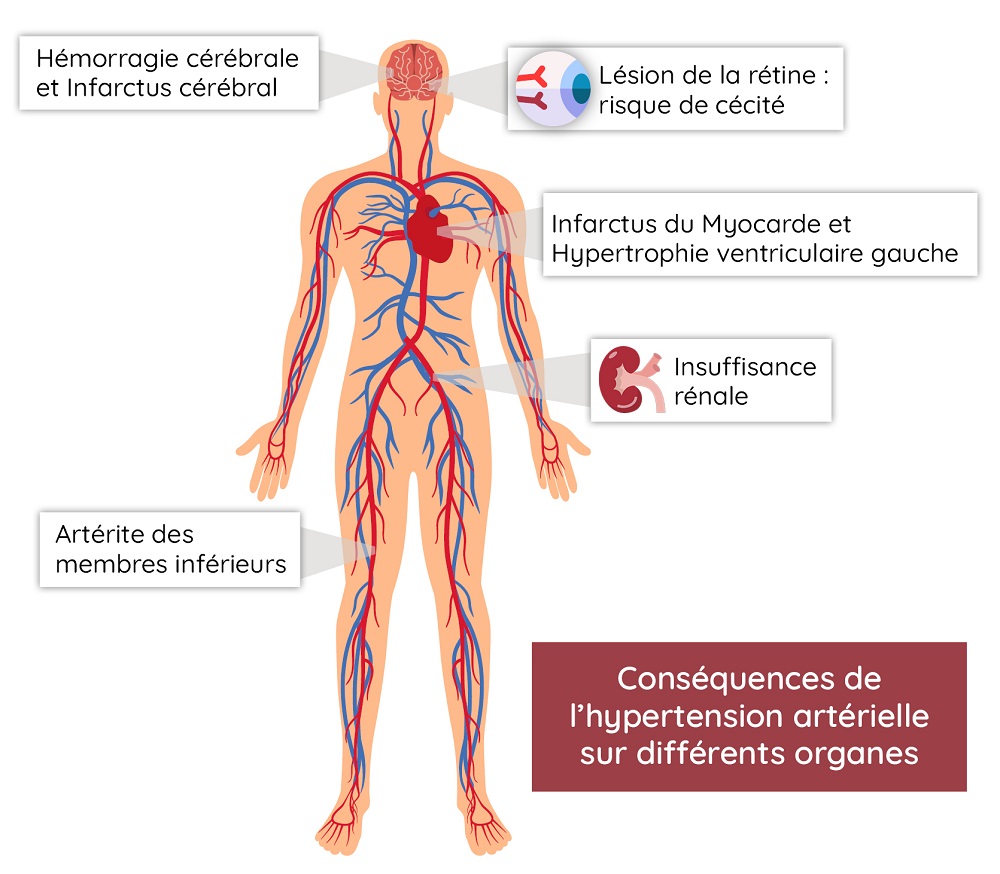 schéma risques AVC